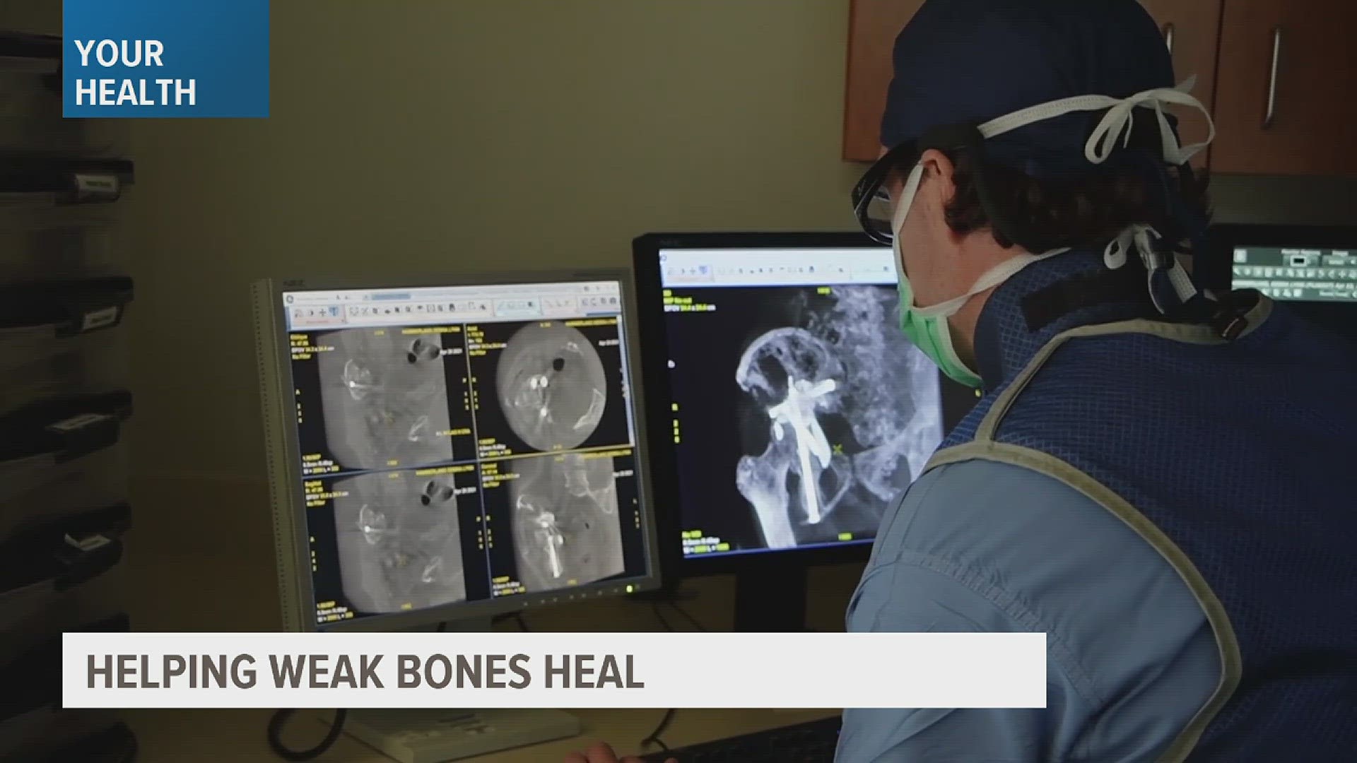 New medical procedures are relieving pain from pelvic and sacral bone fractures.