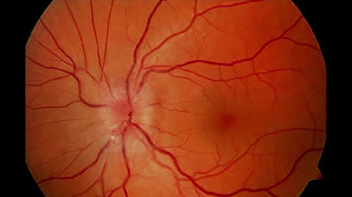 YOUR HEALTH Treating An Eye Stroke Wqad