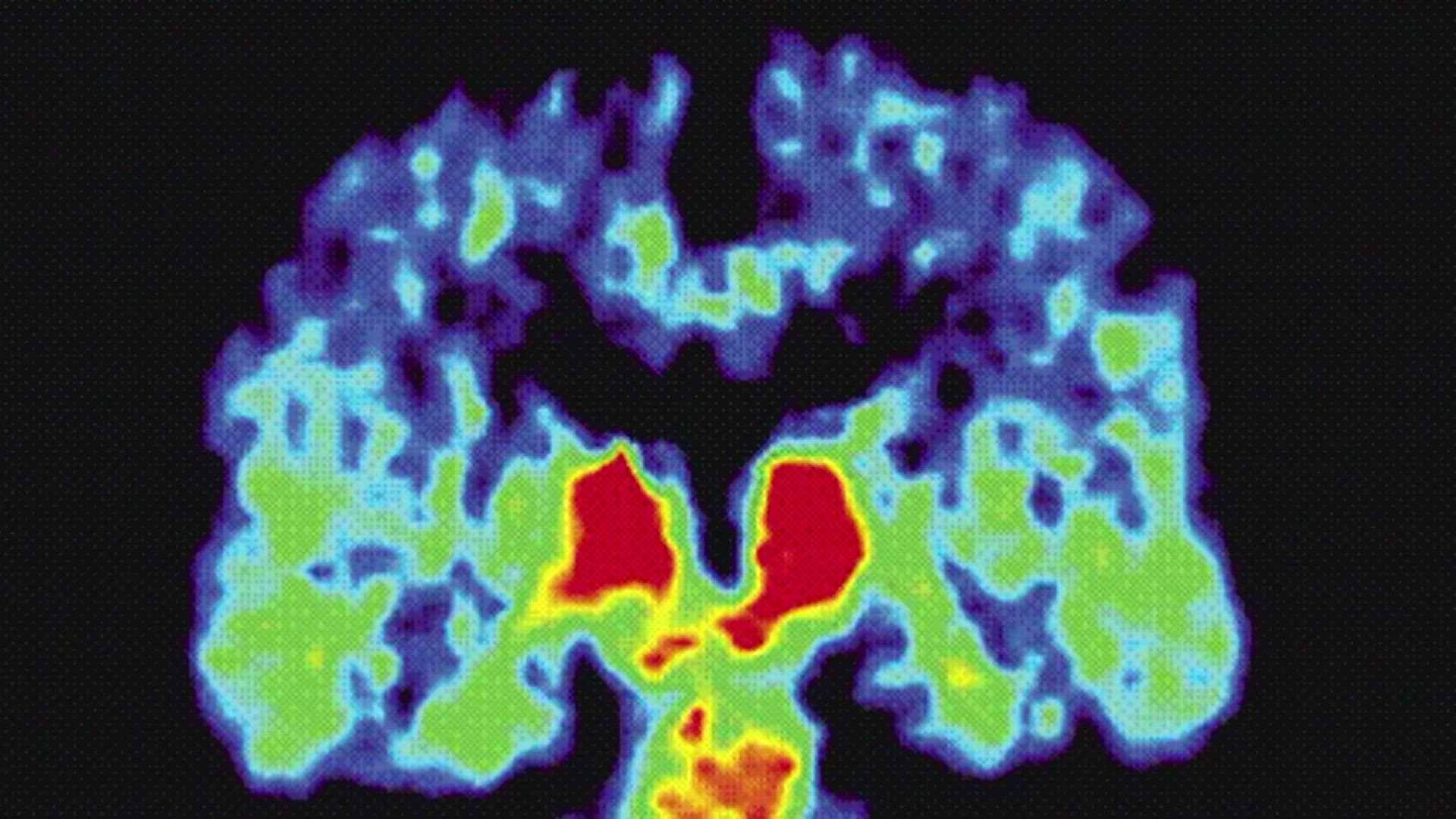 CTE is a brain disease caused by repeated concussions and traumatic brain injury.