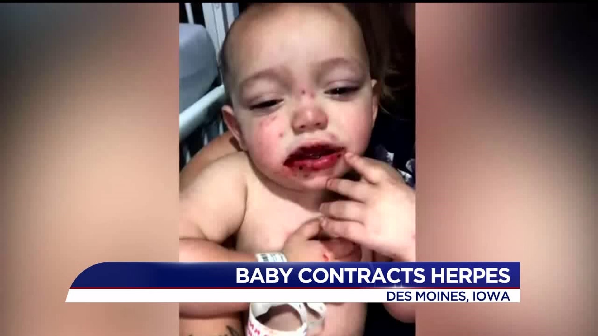 baby contracts herpes from cold sore