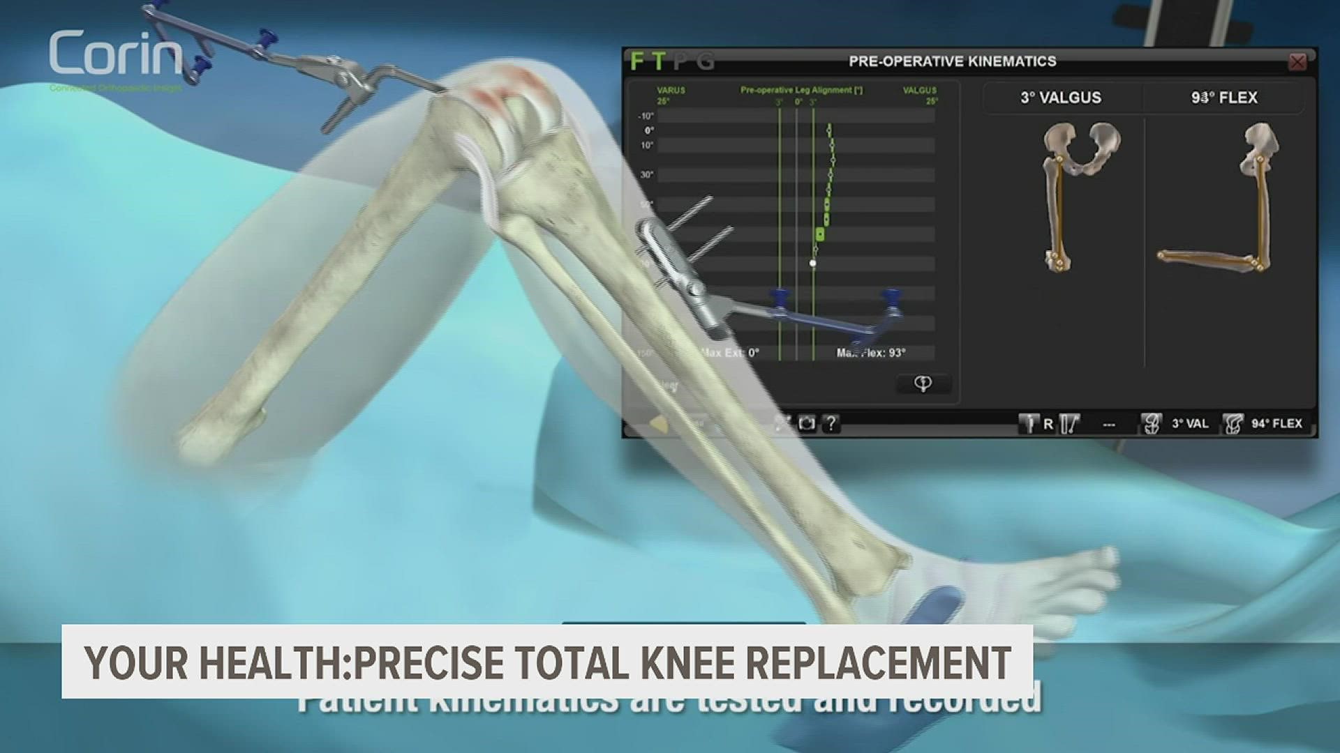 The knee is the most injured joint in the body, and a new technique is giving surgeons a way to make even more precise fixes.