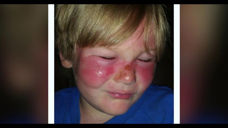 Boy suffers second degree burns even after applying 50 SPF sunscreen ...