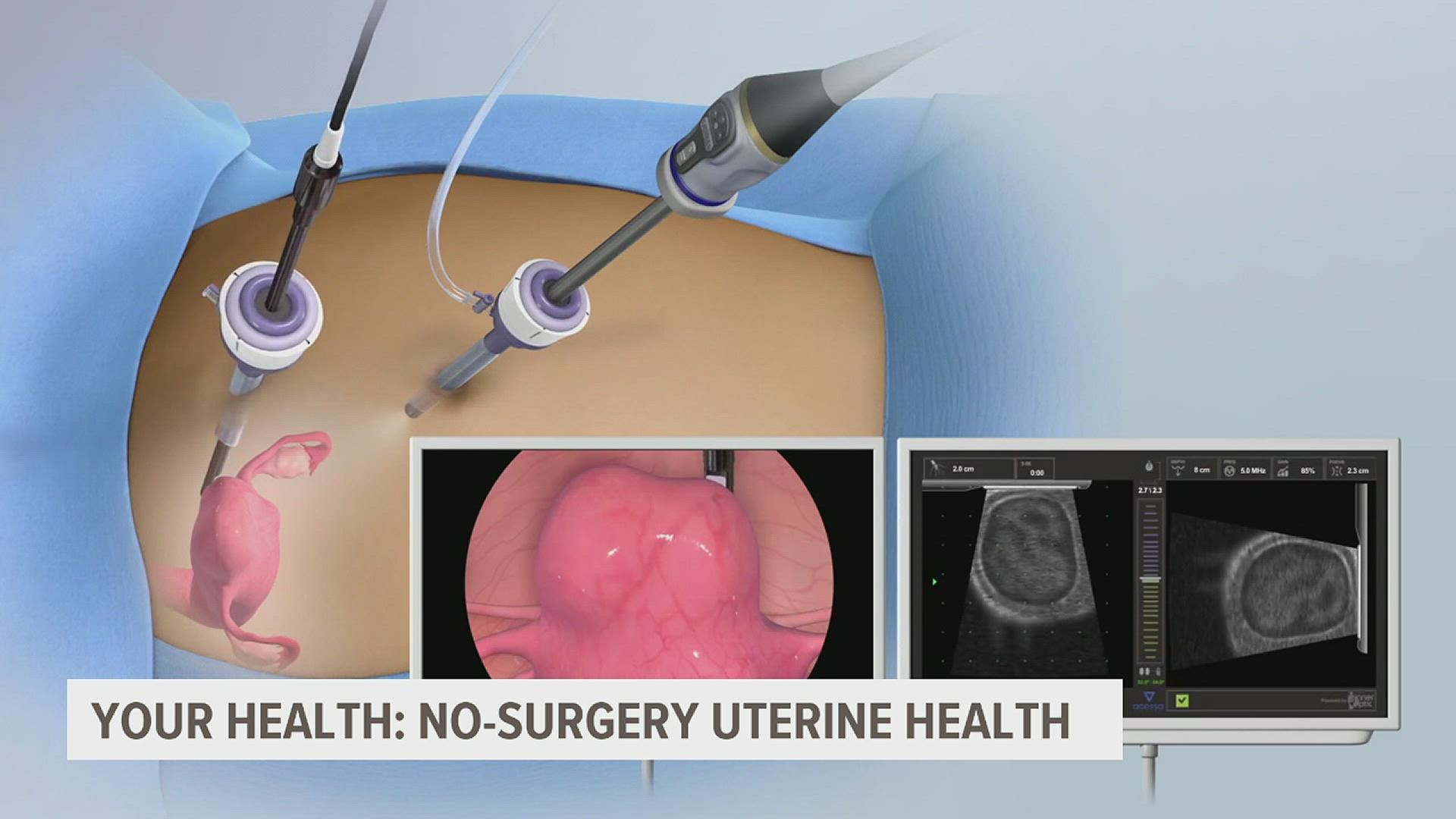 A new laparoscopic procedure is shrinking fibroids and helping women avoid invasive surgery.