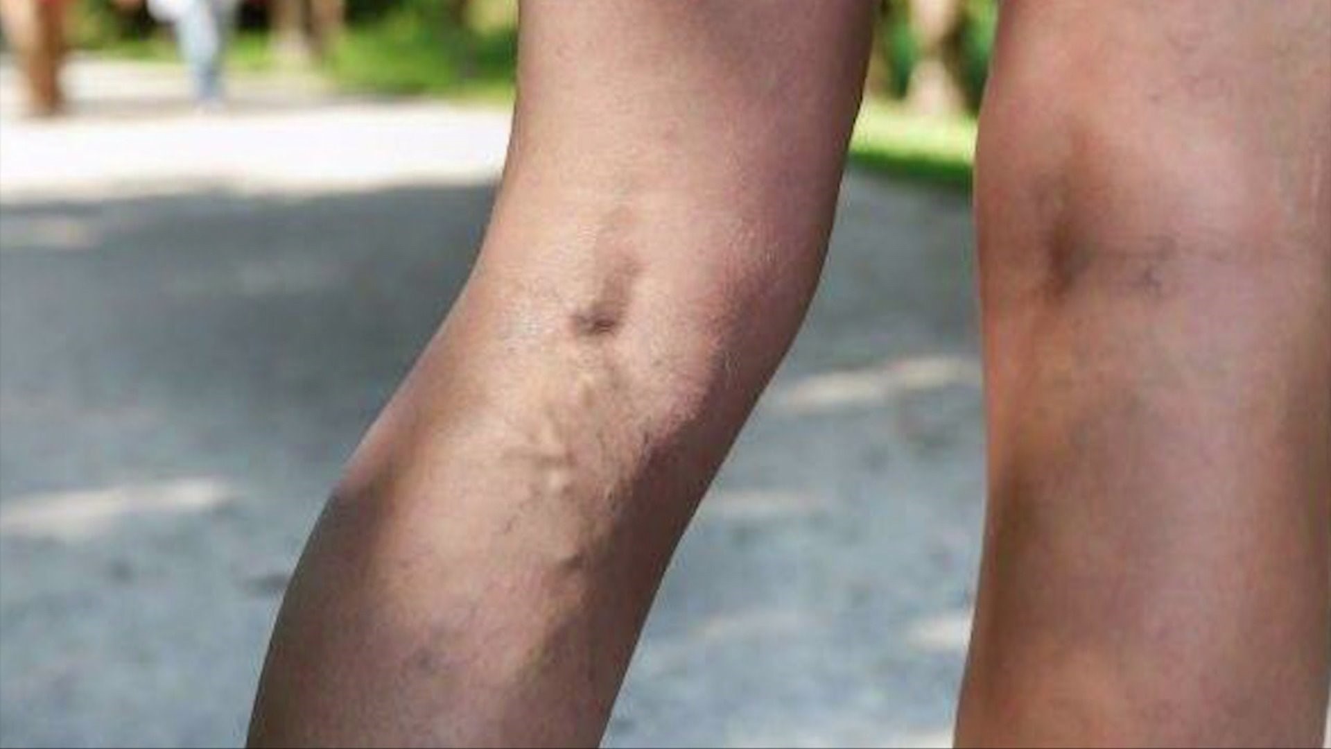 YOUR HEALTH: A new fix for the old problem of varicose veins