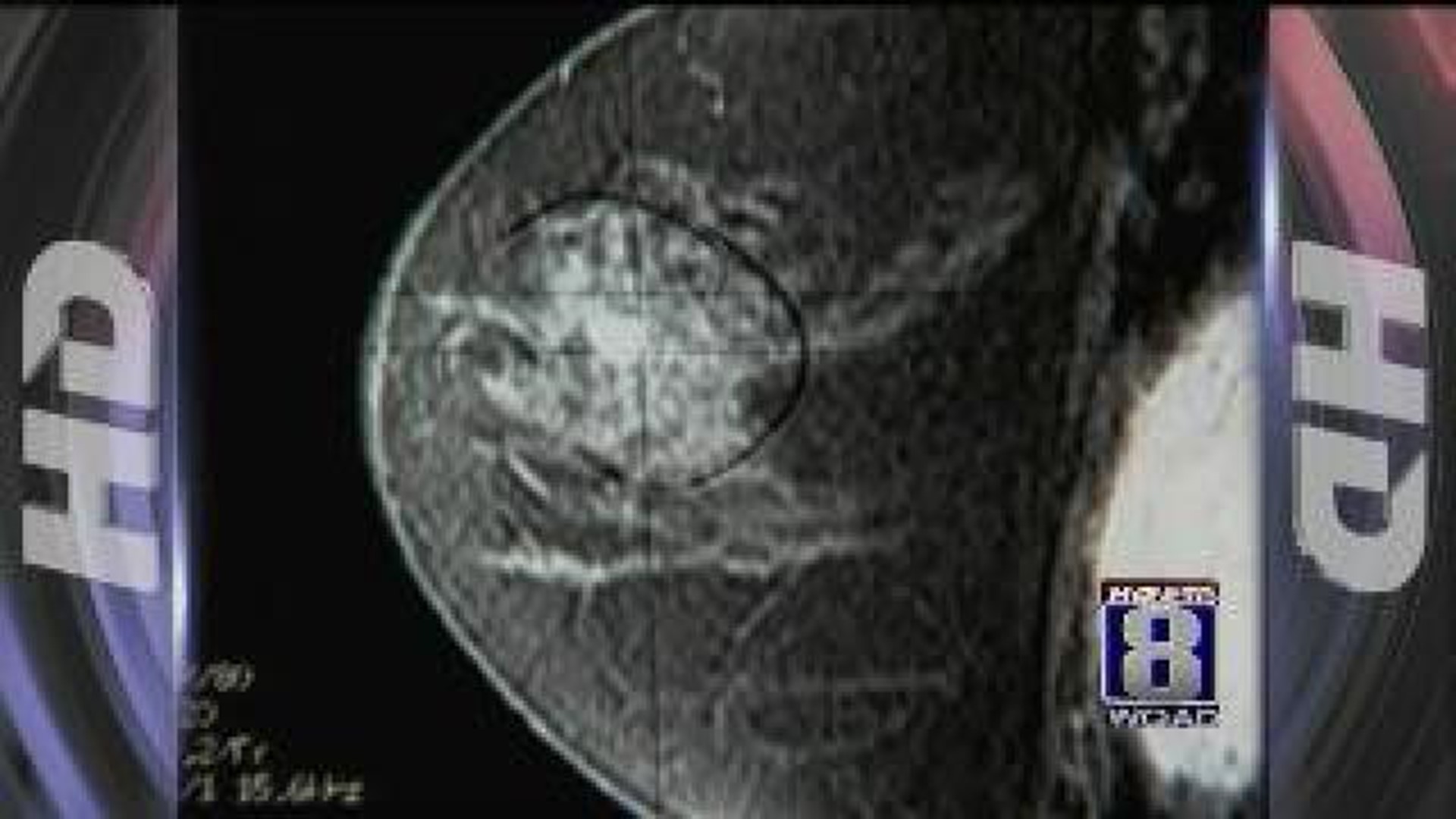 Ultrasounds, MRIs may find developing breast cancer