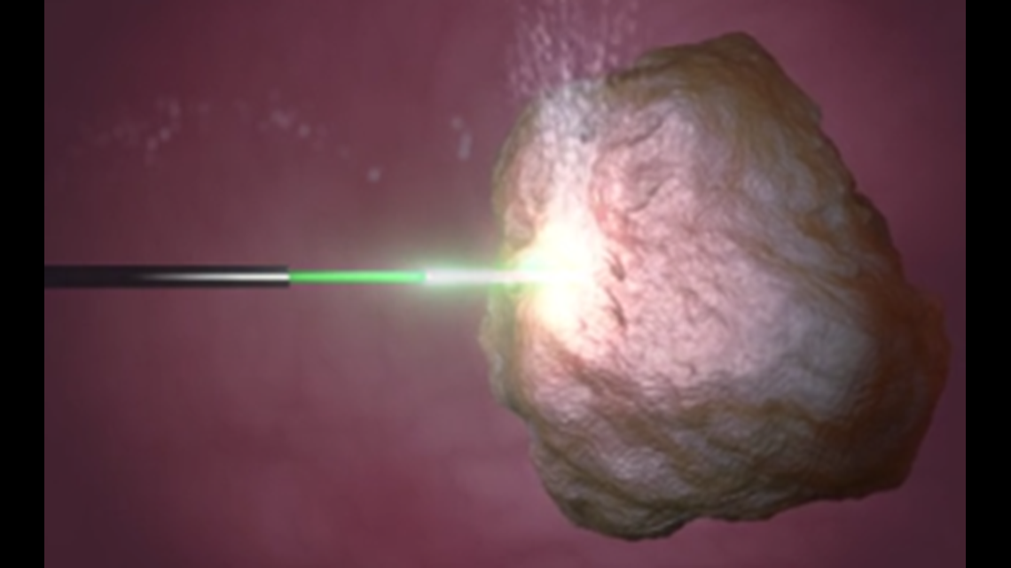 YOUR HEALTH Laser blasting kidney stones