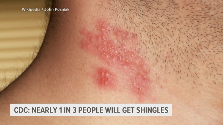 1 in 3 people to develop shingles in their lifetime