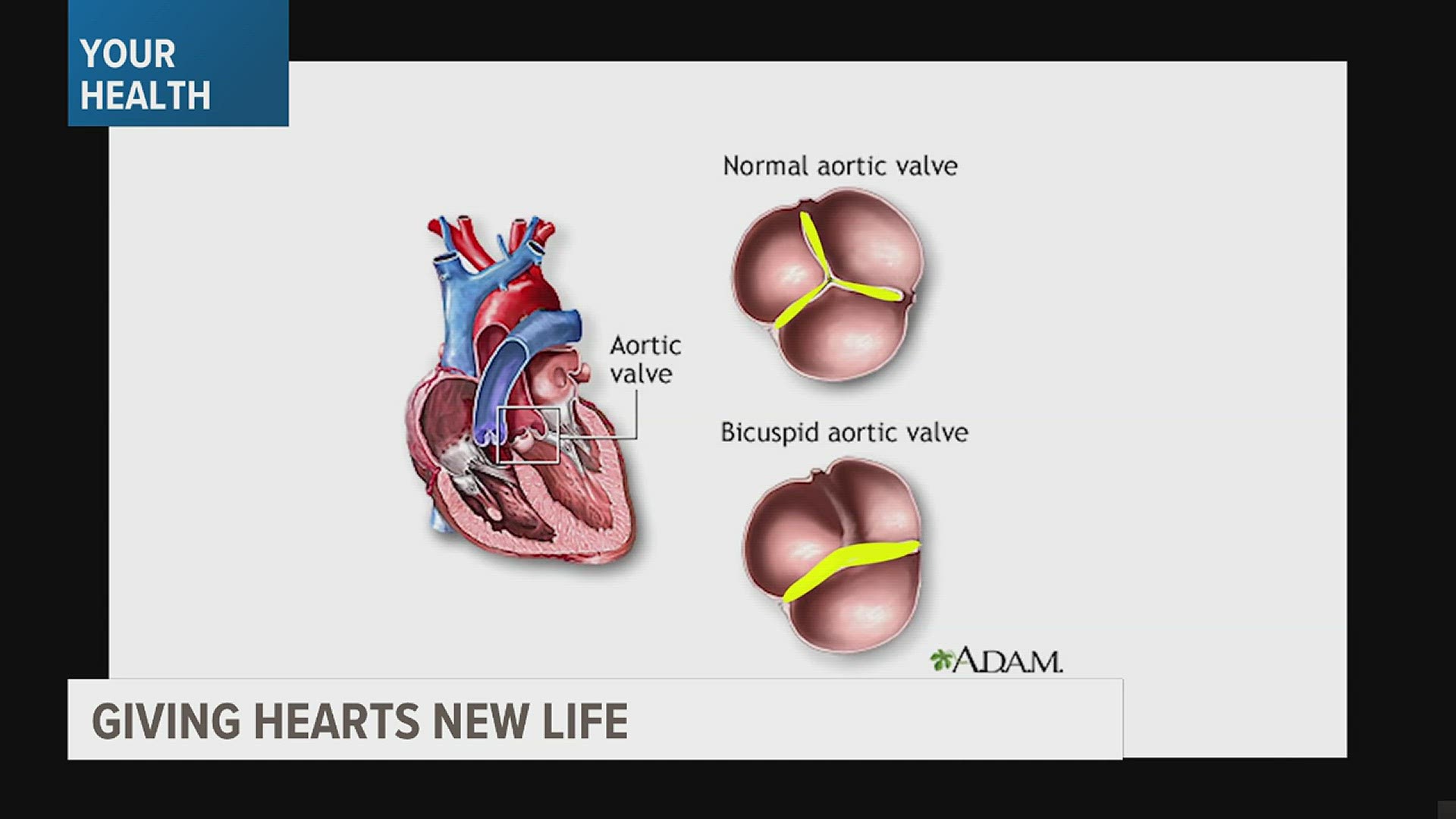 Heart defects in babies are decreasing, however adults with heart defects are rising. One surgeon shares his work in aortic valve replacements.