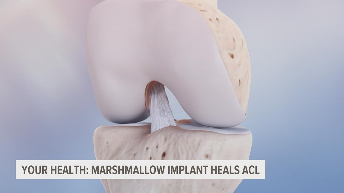 New method to heal ACL | wqad.com - Vimarsana News