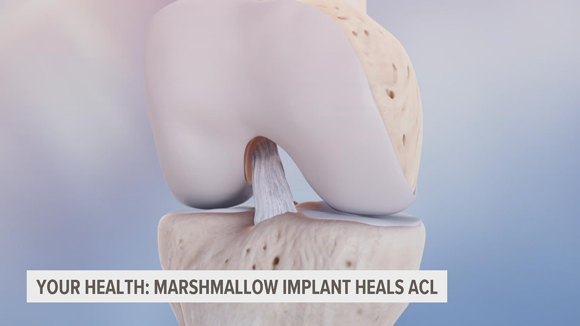 Nearly 200,000 ACL reconstruction surgeries are performed in the U.S. each year, and now, there’s a new less invasive treatment option.