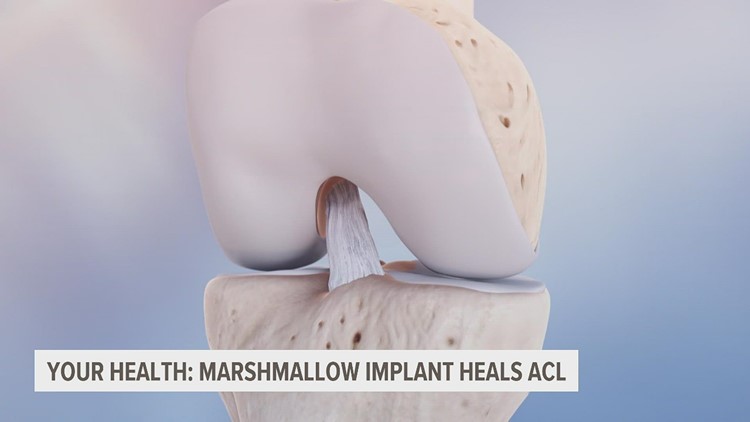 Marshmallow Implant heals ACL from the inside out