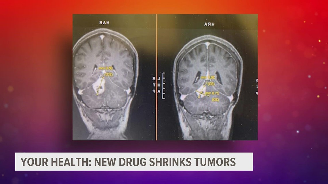 Treating Von Hippel-Lindau disease by shrinking tumors - Vimarsana News
