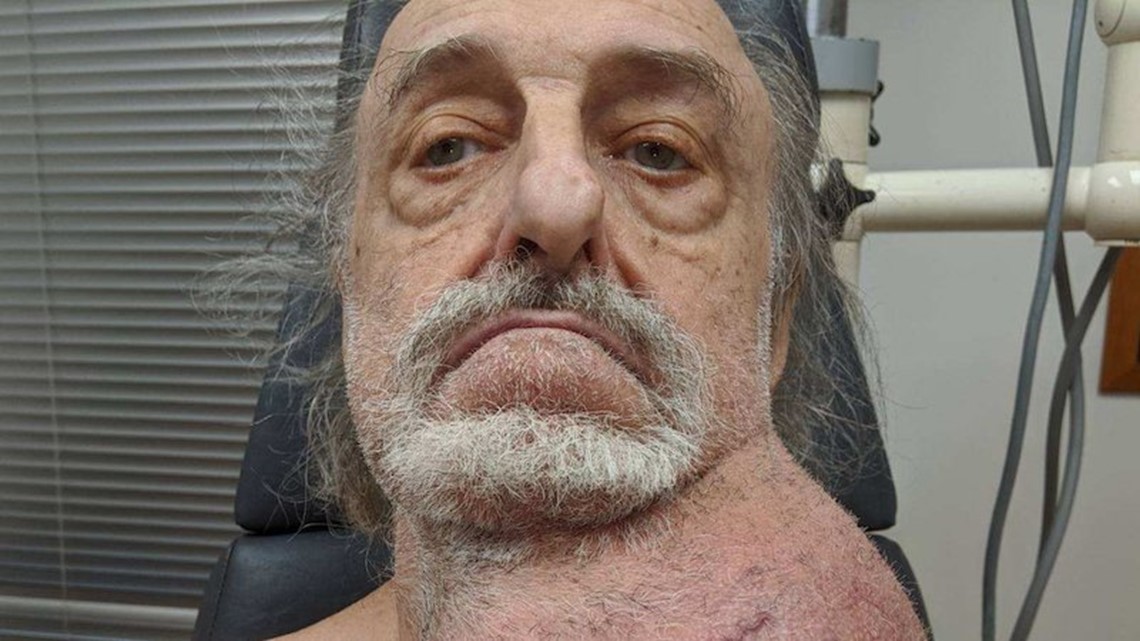Doctors removed a tumor the size of a soccer ball from a man’s neck