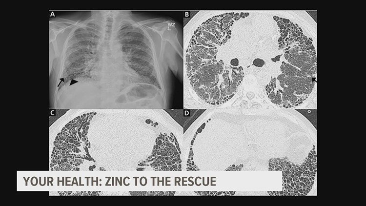 Could zinc be the key to stopping this deadly lung disease?