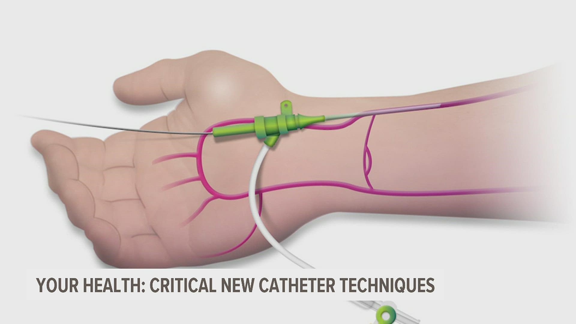 More than a million cardiac catheterization procedures are performed each year in the United States.