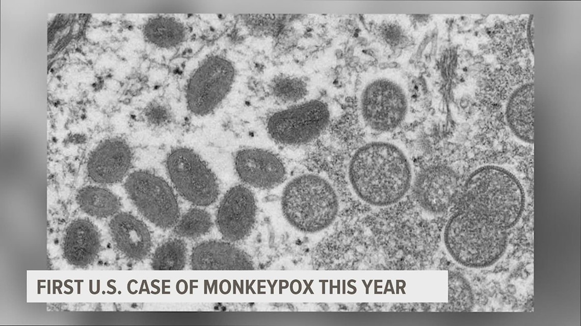US case of monkeypox reported in Massachusetts man