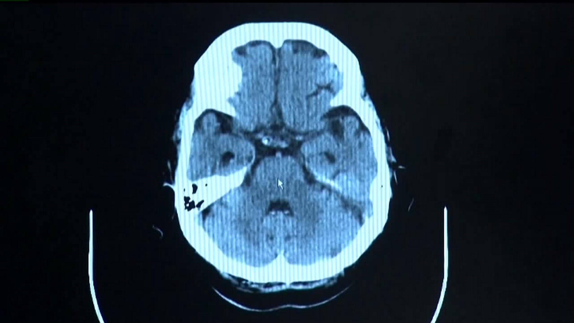 10-year-old girl dies from brain-eating infection