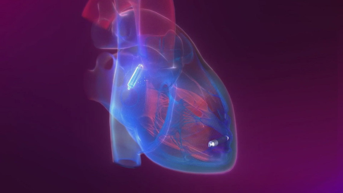 UnityPoint Trinity performs Quad Cities’ first leadless pacemaker ...