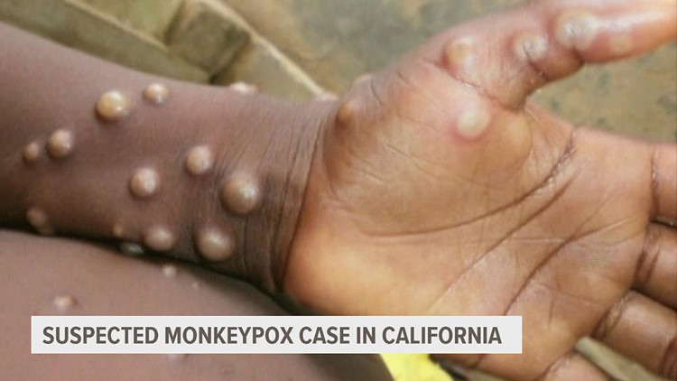 Health officials investigating possible case of Monkeypox in California