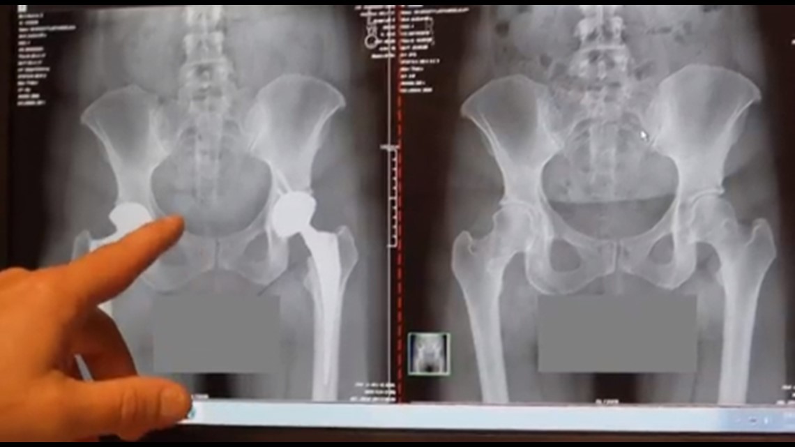 New hip replacement procedure allows greater range of motion 