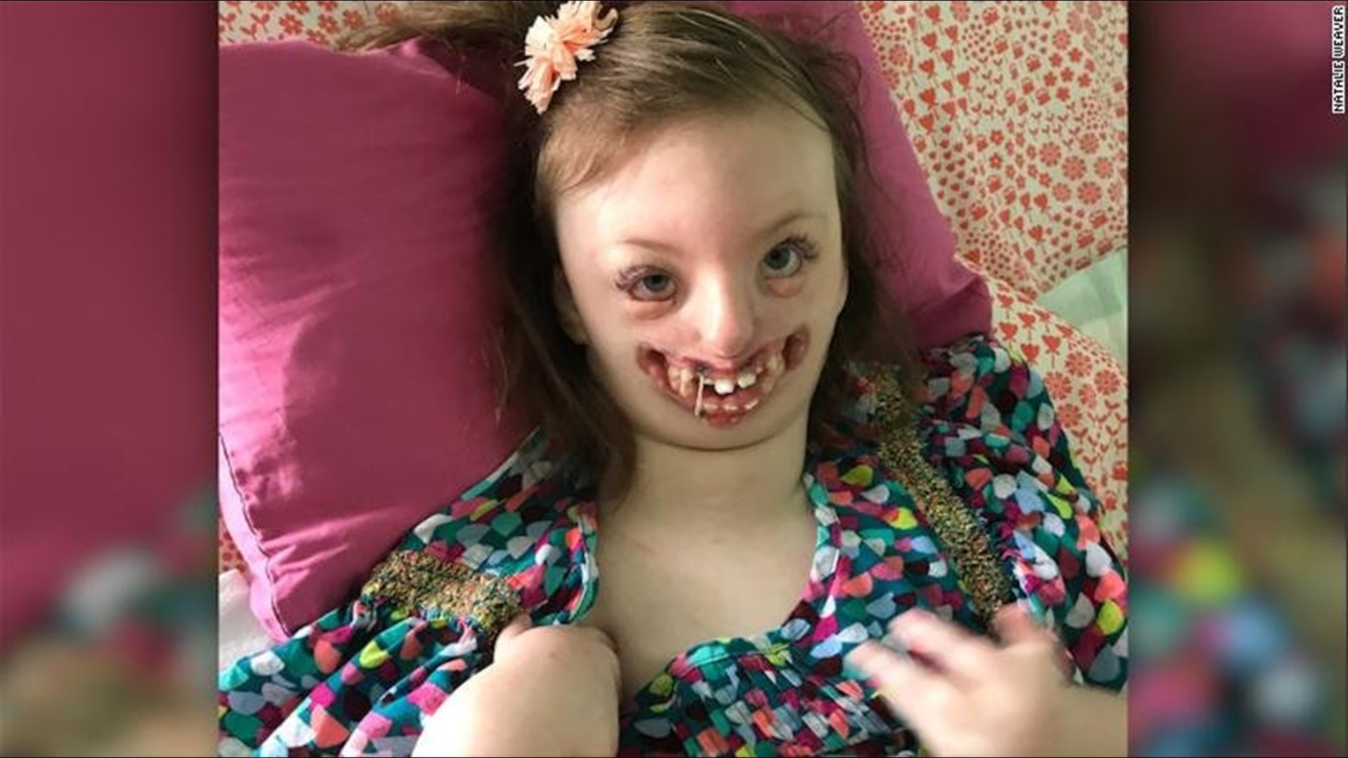 Mom Of Girl With Facial Deformity Fights Twitter Troll Who Used Her