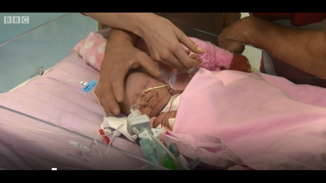Baby survives after being born with heart outside her body | wqad.com
