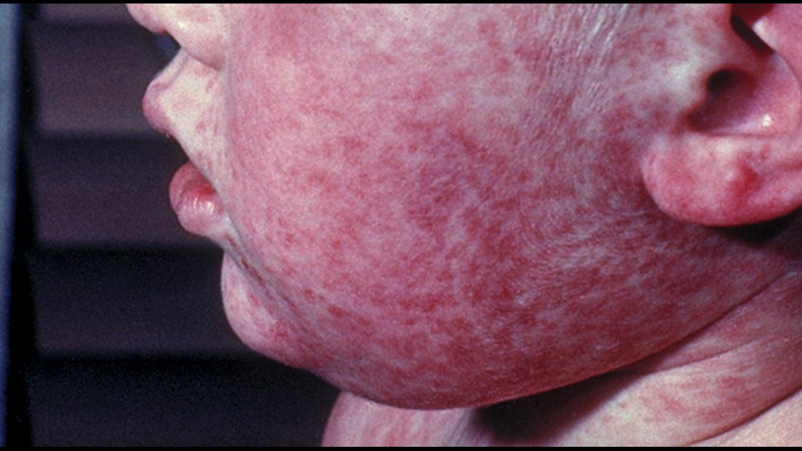 CDC Monitoring Measles Outbreak In 21 States | Wqad.com