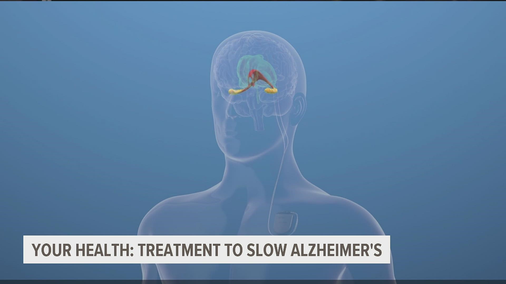 Health officials say the number of people living with Alzheimer's is expected to more than double in the next 30 years.