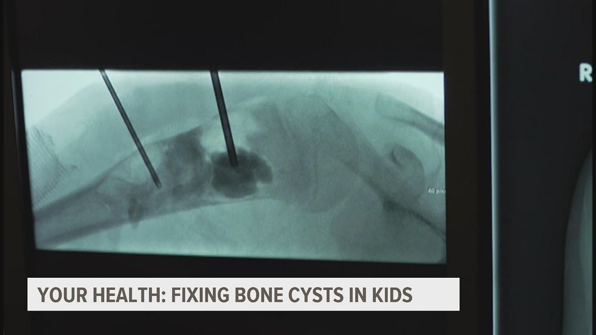 A new technique is helping kids with brittle bones strengthen their skeleton and live normal kid lives.