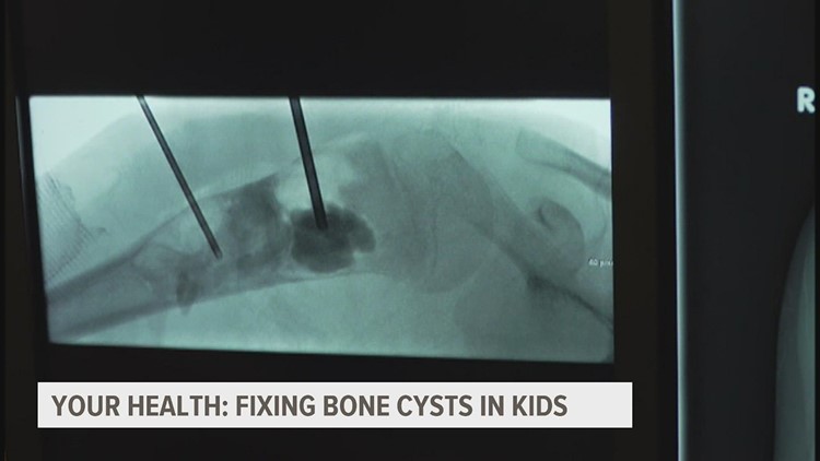 Brittle bones: How researchers are treating bone cysts in children