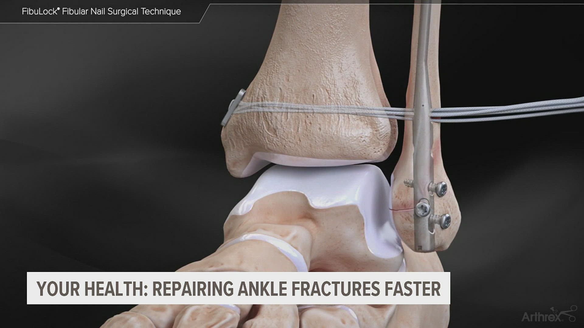 Ankle fractures, usually caused by twisting an ankle, are one of the most common injuries. Now, new technology is allowing patients to get up and get moving faster.