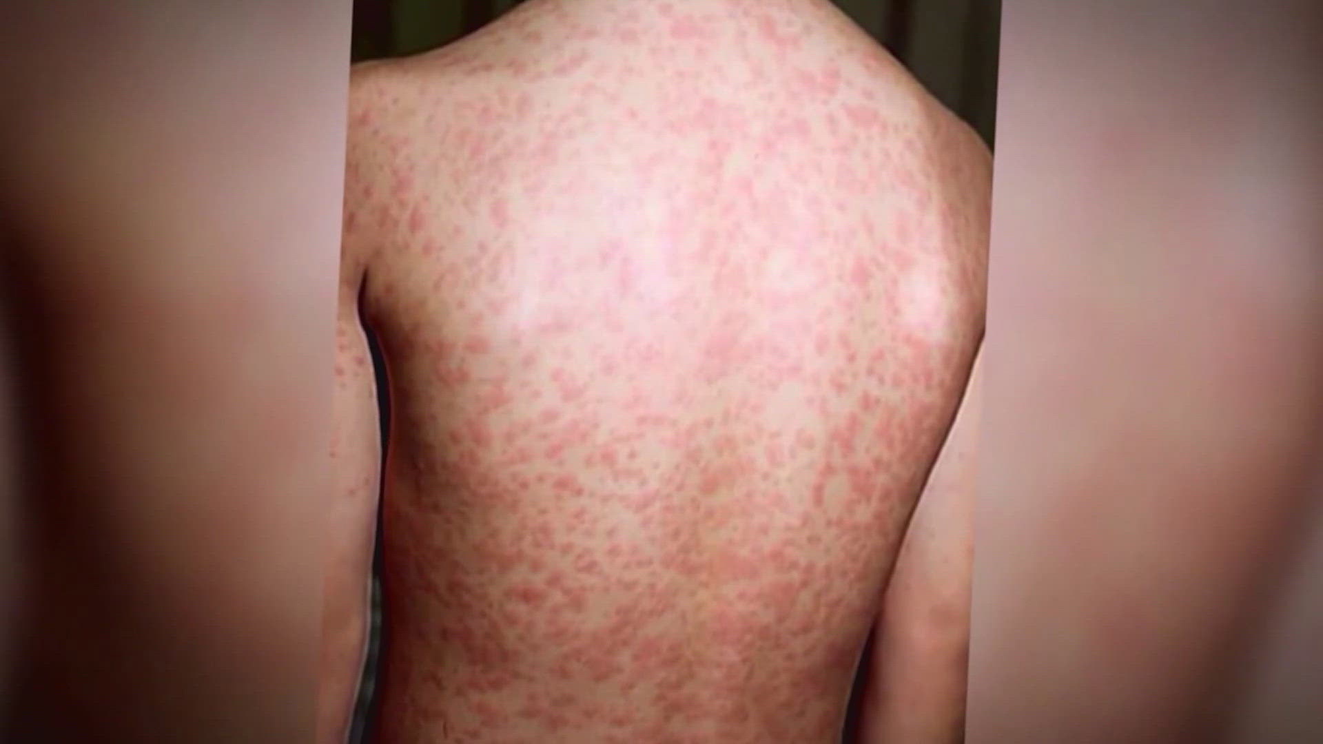 As of June, Iowa had six cases of measles. 