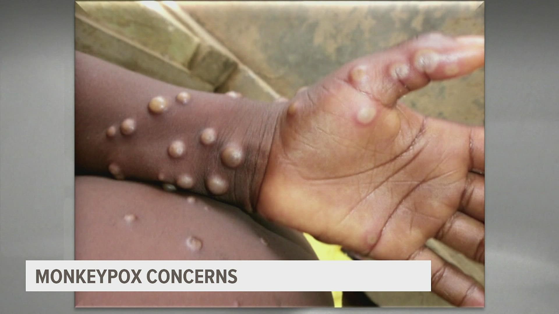 WHO estimates the disease is fatal for up to one in 10 people, but smallpox vaccines are protective and some antiviral drugs are being developed.