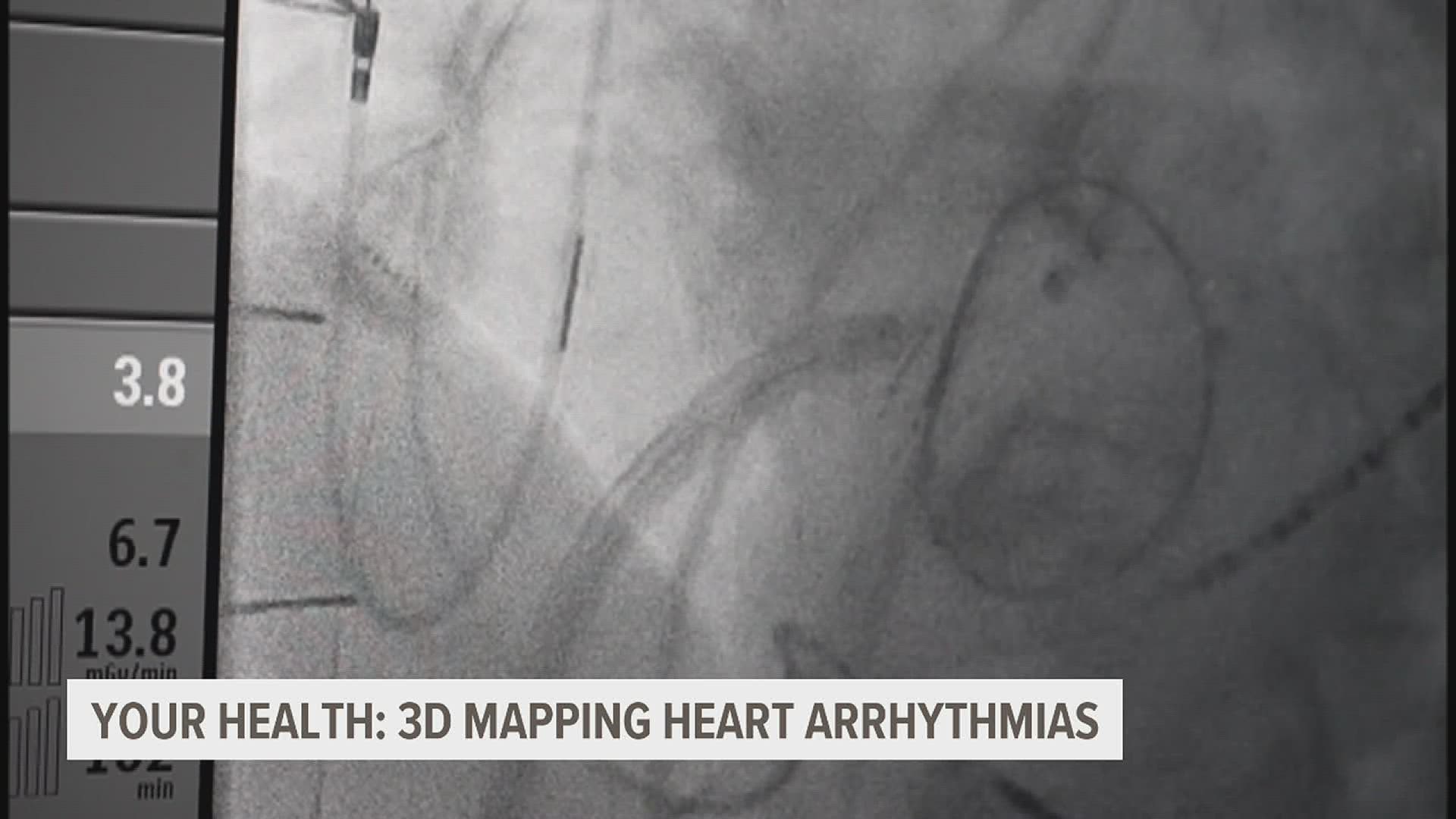One in 18 people in the U.S. has heart arrhythmia. But now, for the first time in America, researchers are using a 3D mapping system to help treat the disorder.