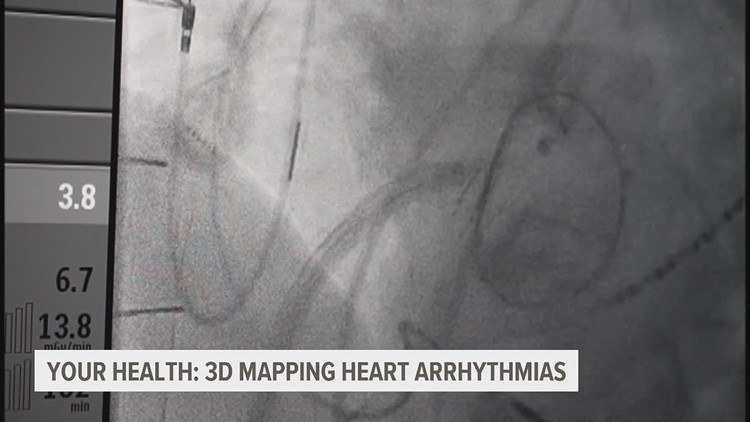 3D mapping: The new way to diagnose and treat heart arrhythmia
