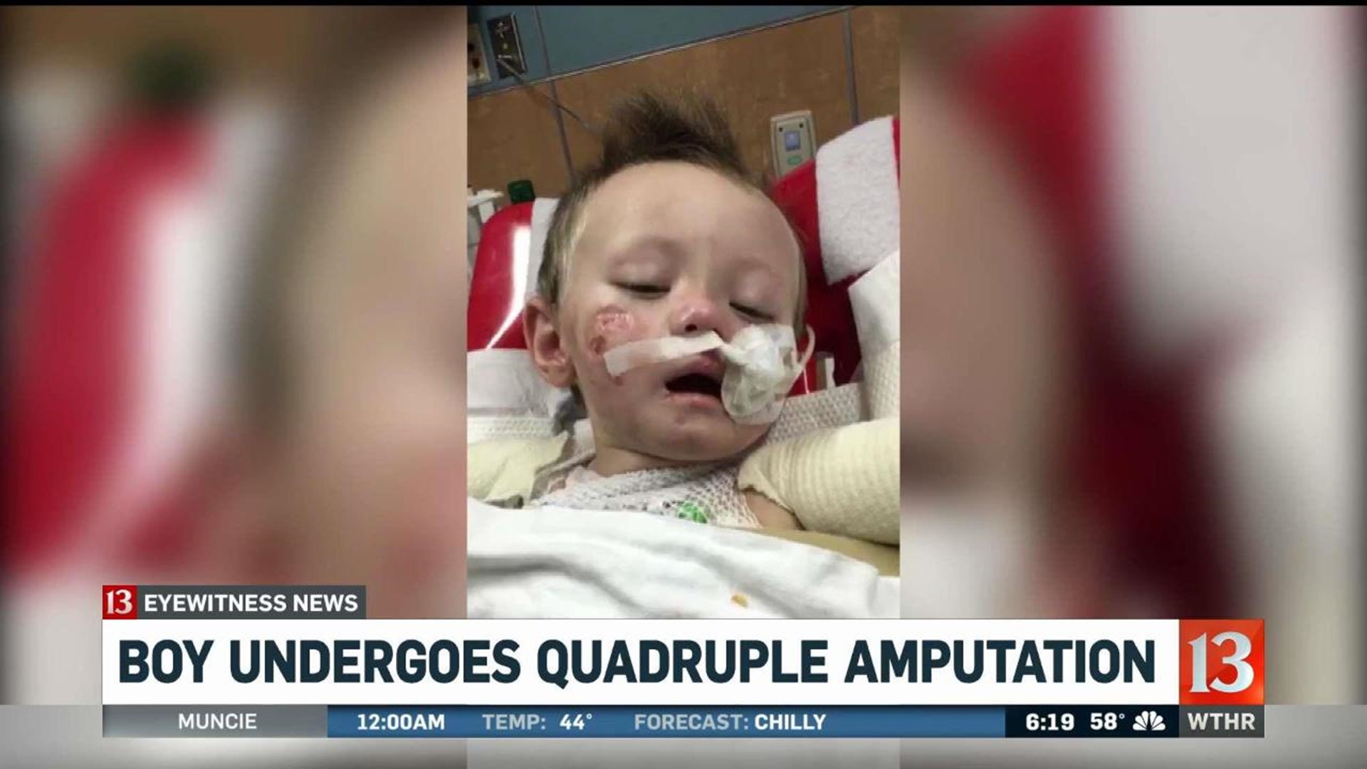Boy undergoes quadruple amputation