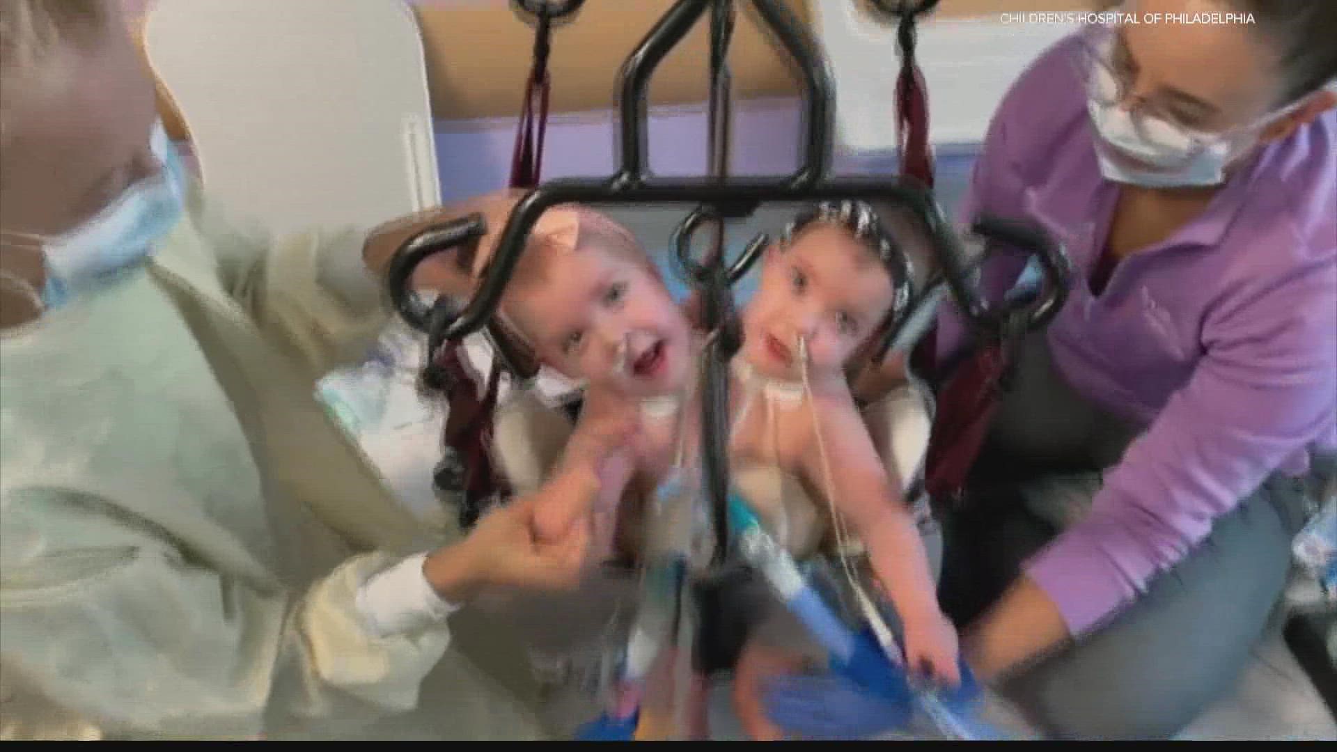 How are the Altobelli conjoined twins doing today? All the details 