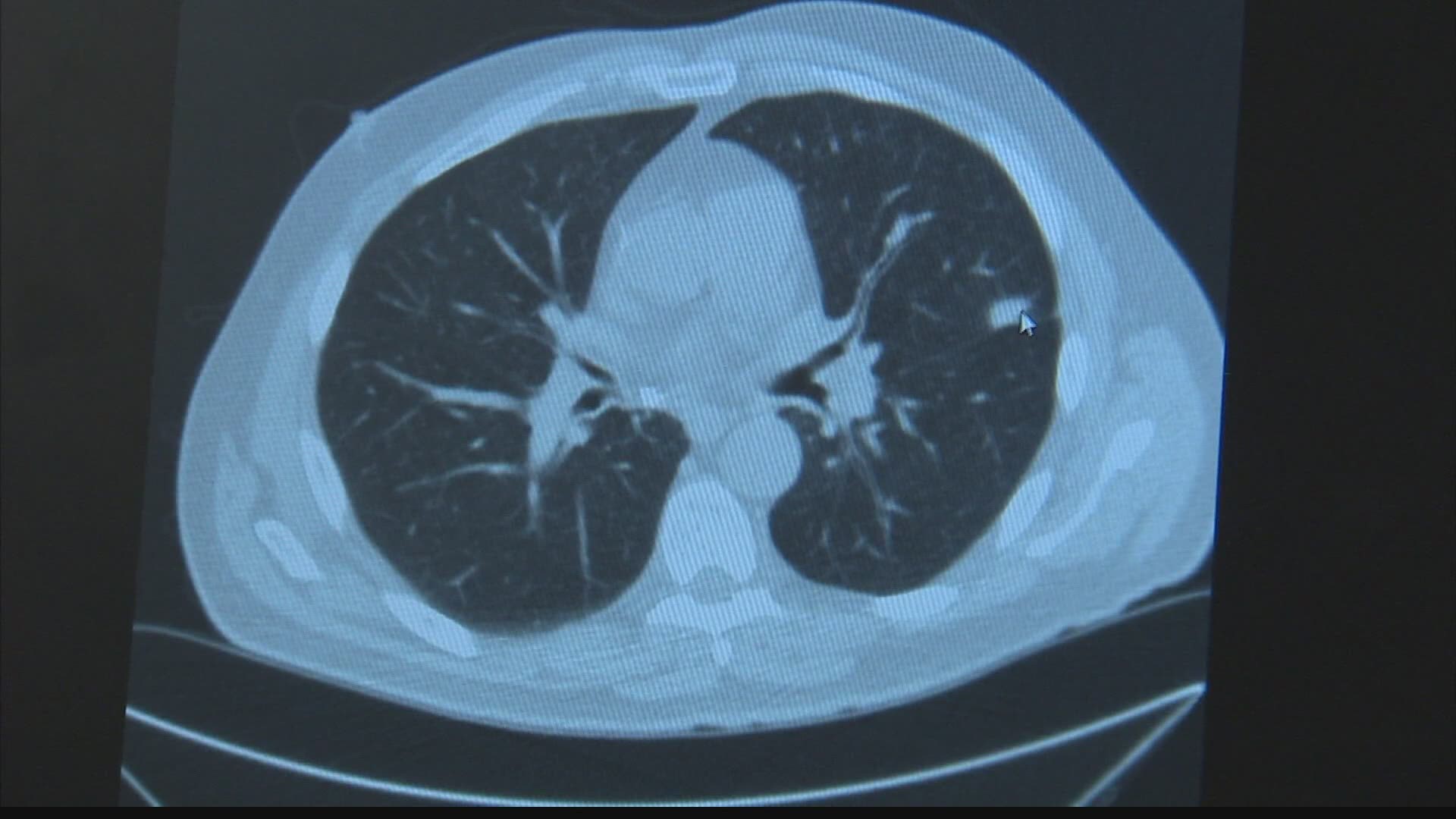 Check Up 13: Low-dose CT scan detects lung cancer early in some