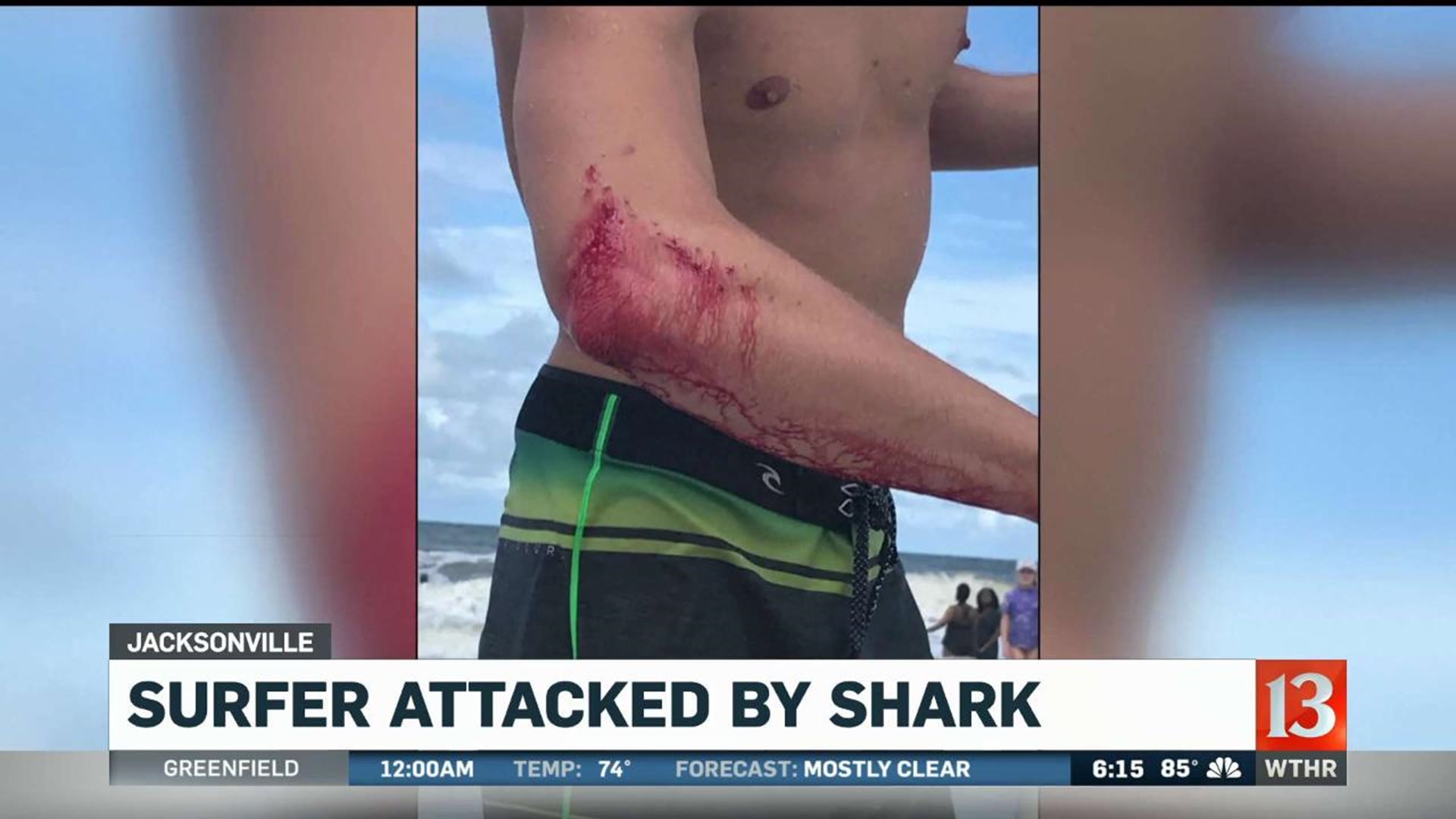 Surfer In Florida Bitten By Shark