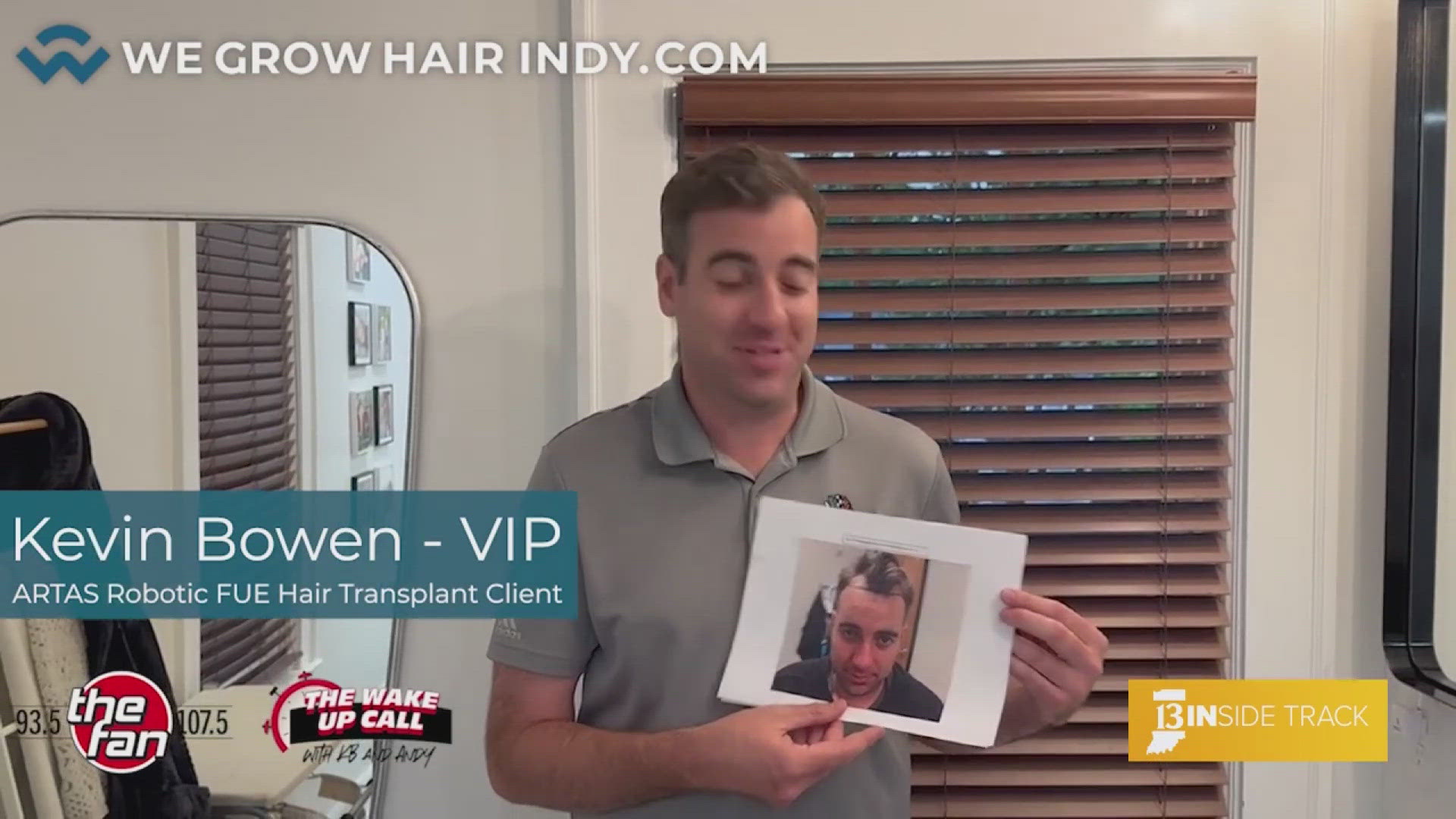 Artas Robotic FUE hair transplants at We Grow Hair Indy | wthr.com