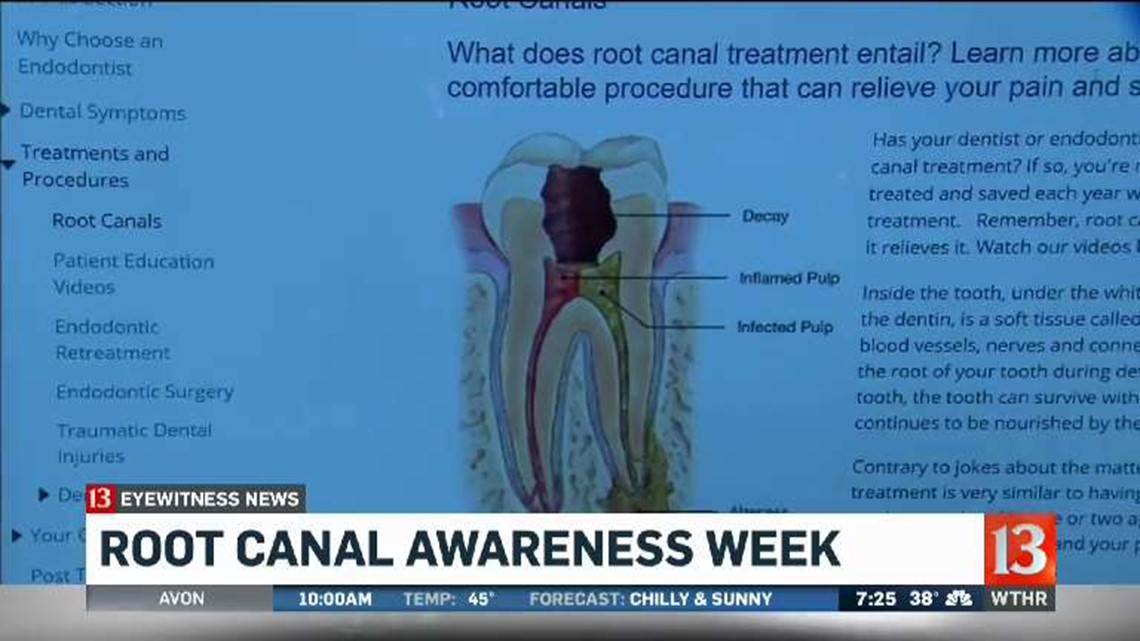 WATCH Root canal awareness week