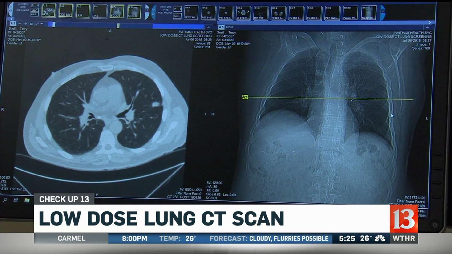 Check Up 13: Low dose lung CT scan