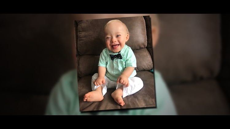 gerber baby with down syndrome