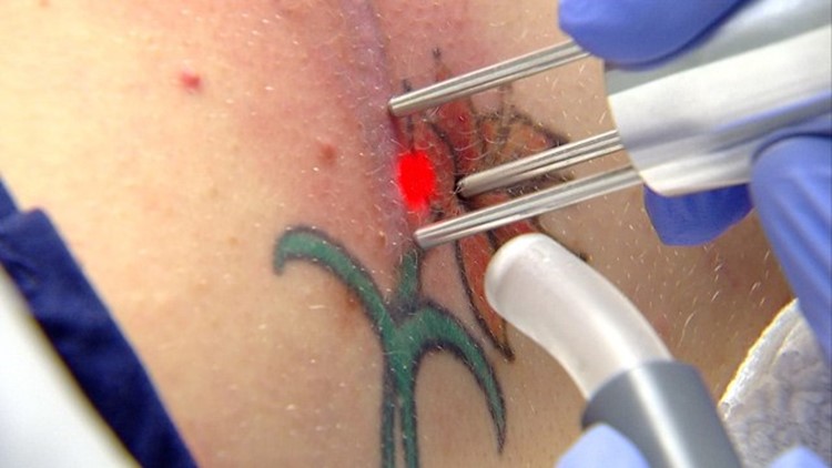 Laser Tattoo Removal - Laser & Light Surgery Center