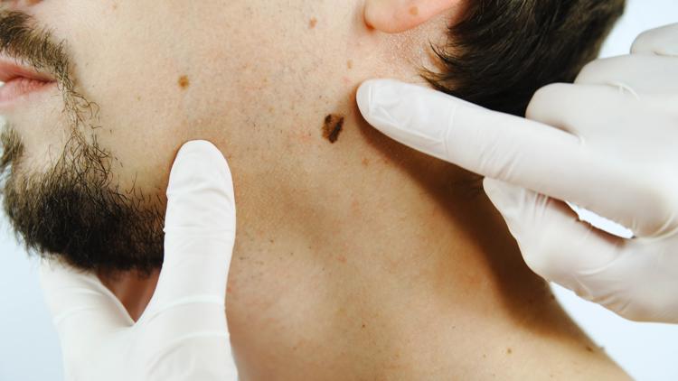 Melanoma, skin cancer in men | Real Men Wear Gowns