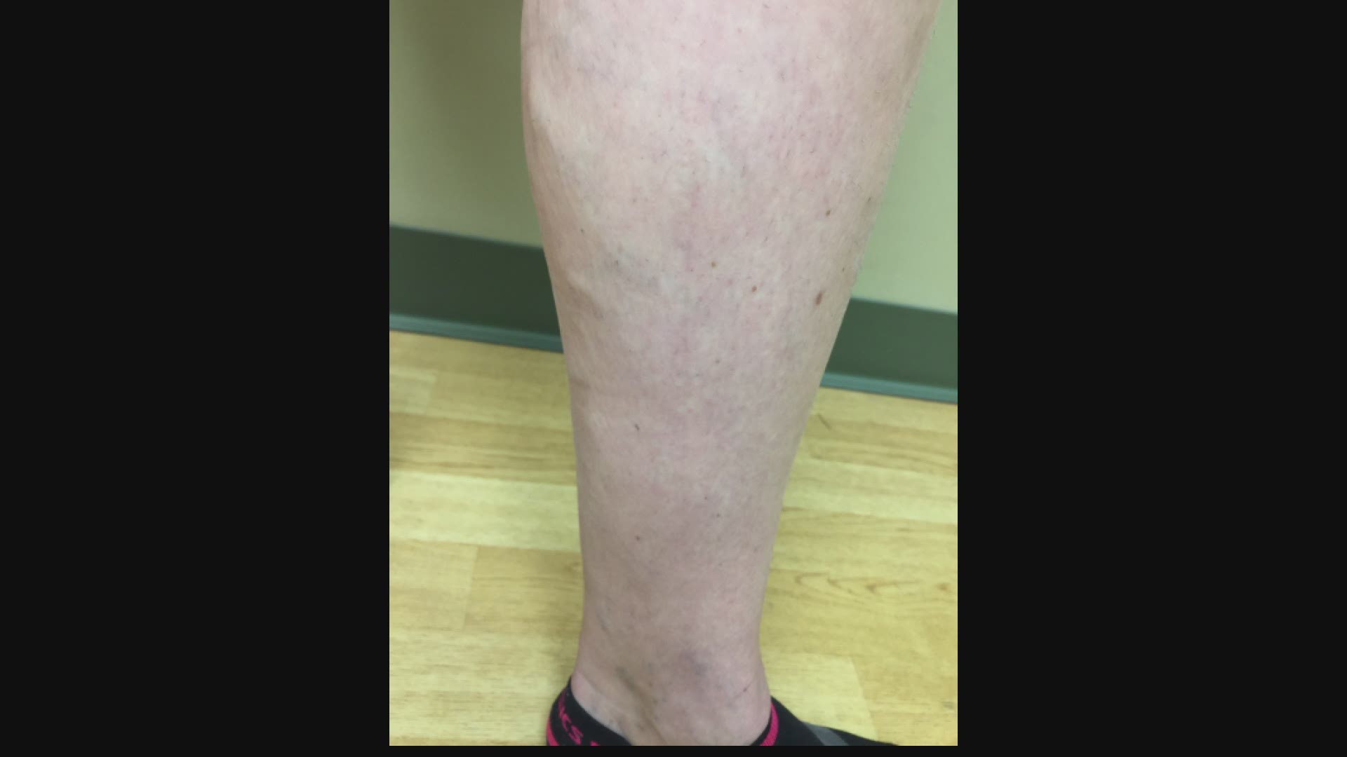 If you have varicose veins, you probably don't like the way they look, but you really don't like how they feel.