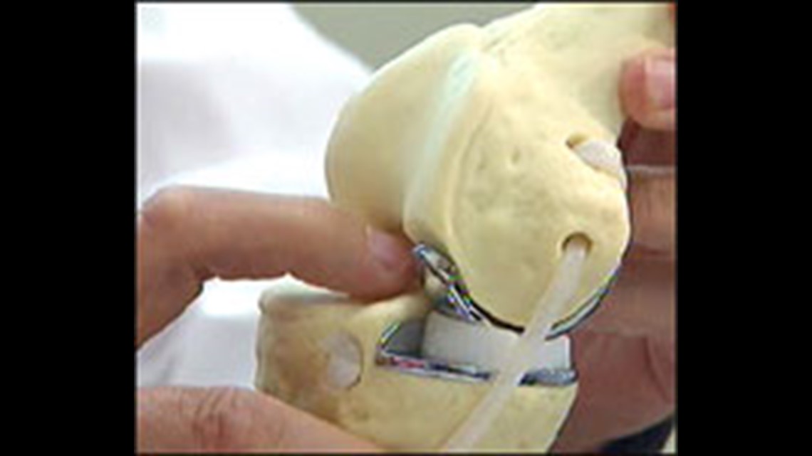 Oxford Knee Is Long Lasting Partial Knee Replacement