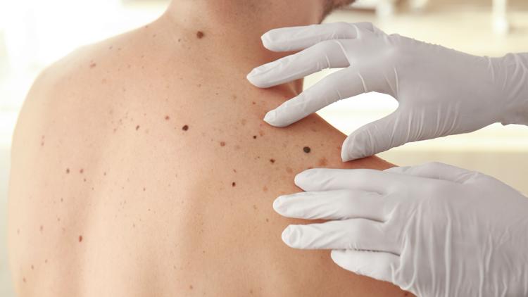 Skin cancer prevention and detection | Real Men Wear Gowns