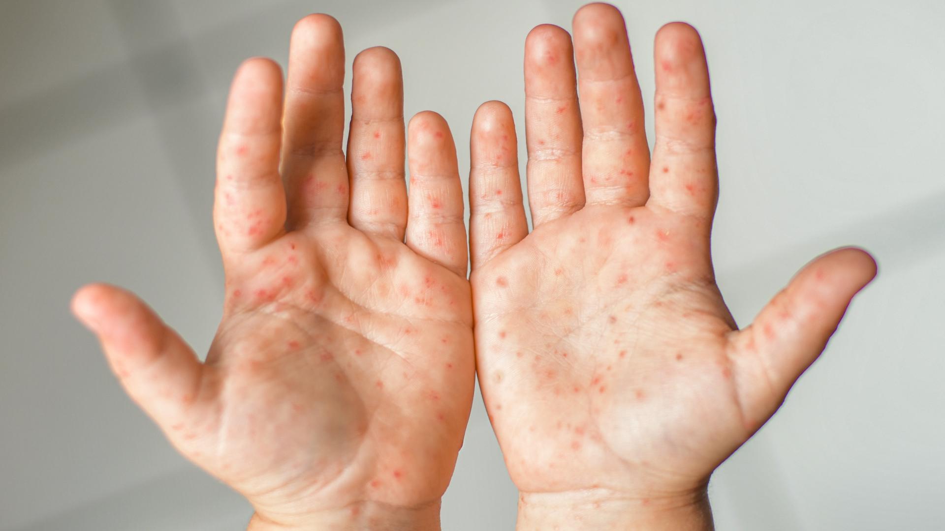A Tippecanoe School Corporation spokesperson confirmed its aware of several confirmed and suspected cases of the disease at TSC schools.