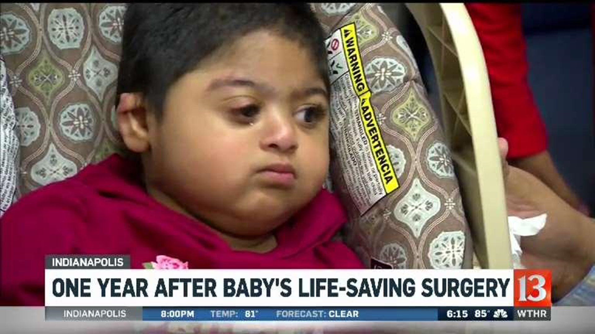 One year after baby's life-saving surgery